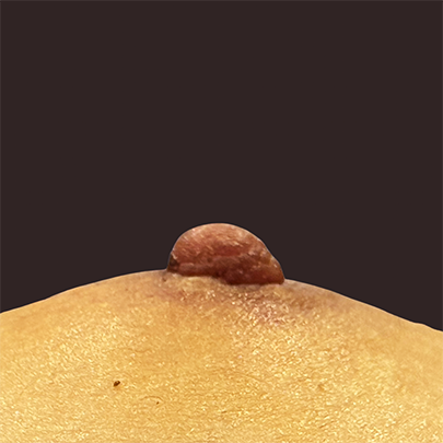 症例A｜乳頭縮小術（乳管温存法）