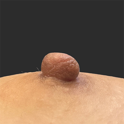 症例A｜乳頭縮小術（乳管温存法）