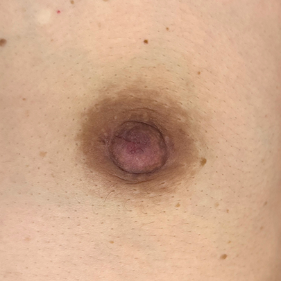 症例B｜陥没乳頭