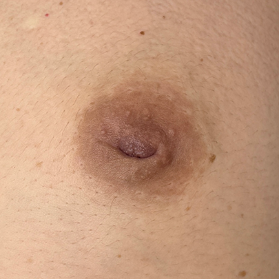 症例B｜陥没乳頭